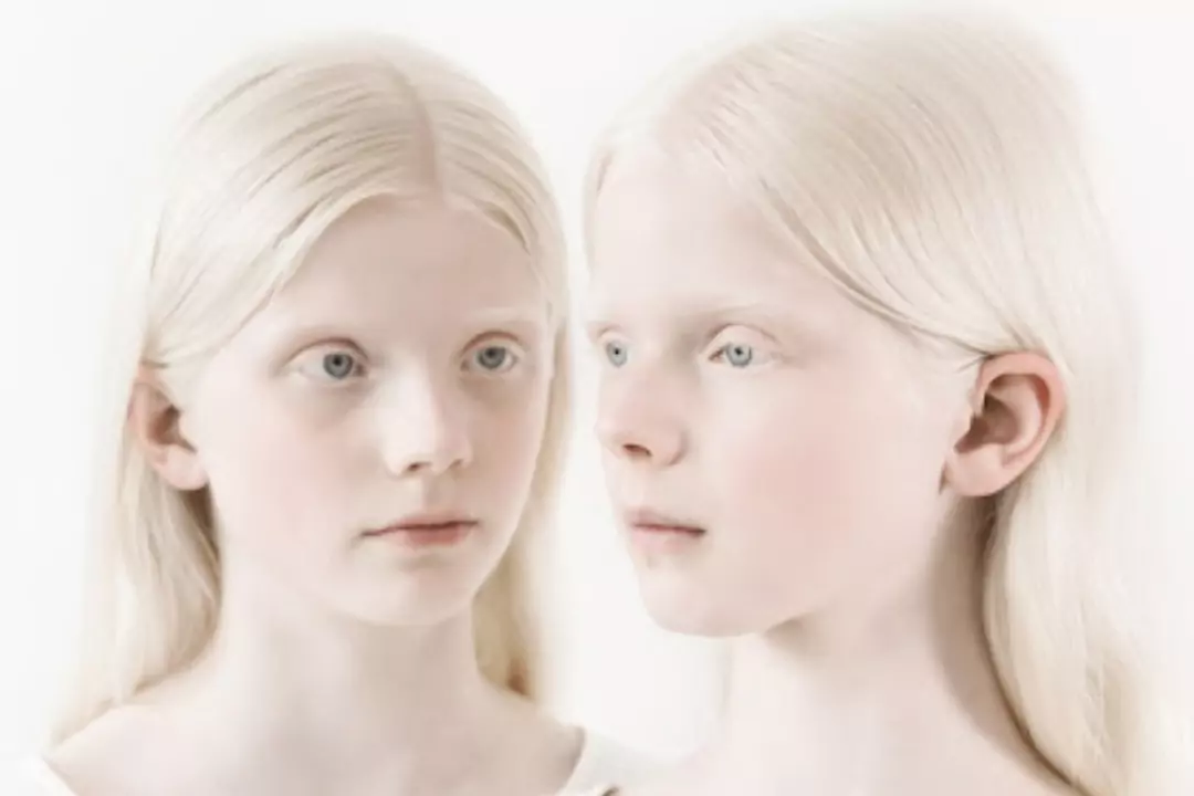 Альбинизмом страдают. Генетические заболевания альбинизм. Генные болезни альбинизм. Глазокожный альбинизм Тип 1а.