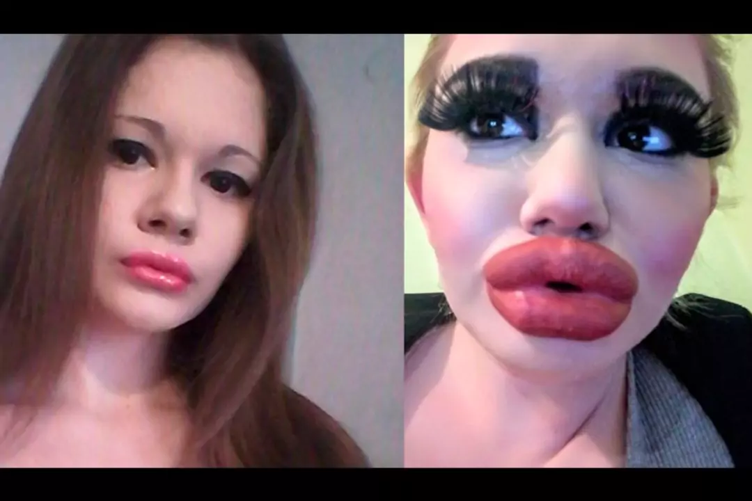24-летняя девушка хочет, чтобы ее губы признали самыми большими в мире. Поддерживать красоту приходится ежемесячными уколами.