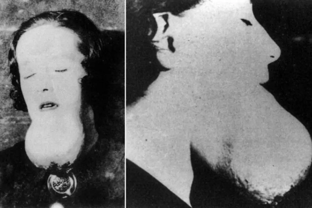 В 1923 году умерла первая художница циферблатов, а перед смертью у неё отвалилась челюсть Изображение статьи