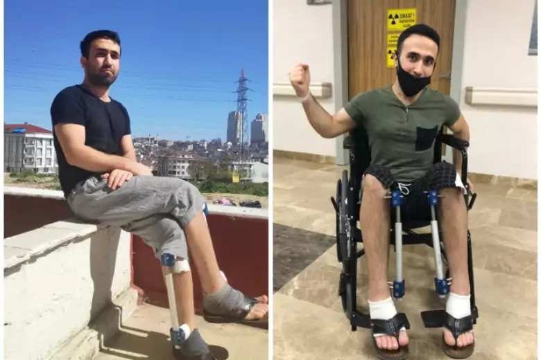 30-летний Ибрагим Алган выложил $ 27 000 за операцию по удлинению ног, чтобы повысить уверенность в себе и избежать косых взглядов в свою сторону.