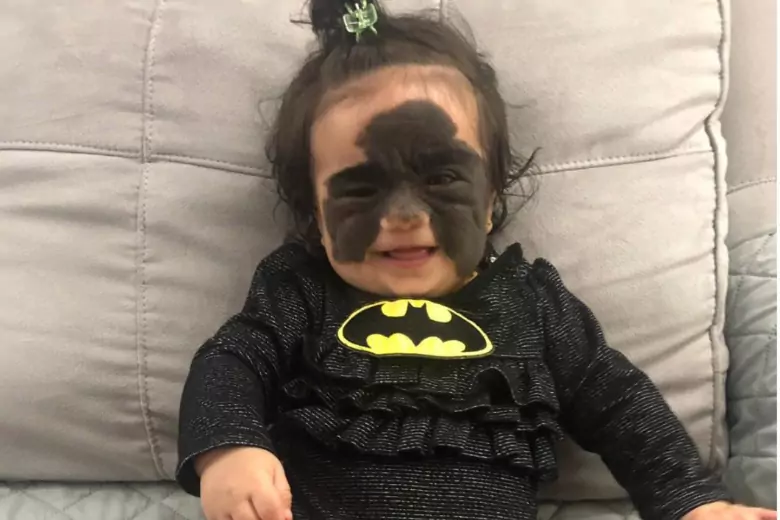 Российский хирург избавил юную американку от врождённой «маски Бэтмена»