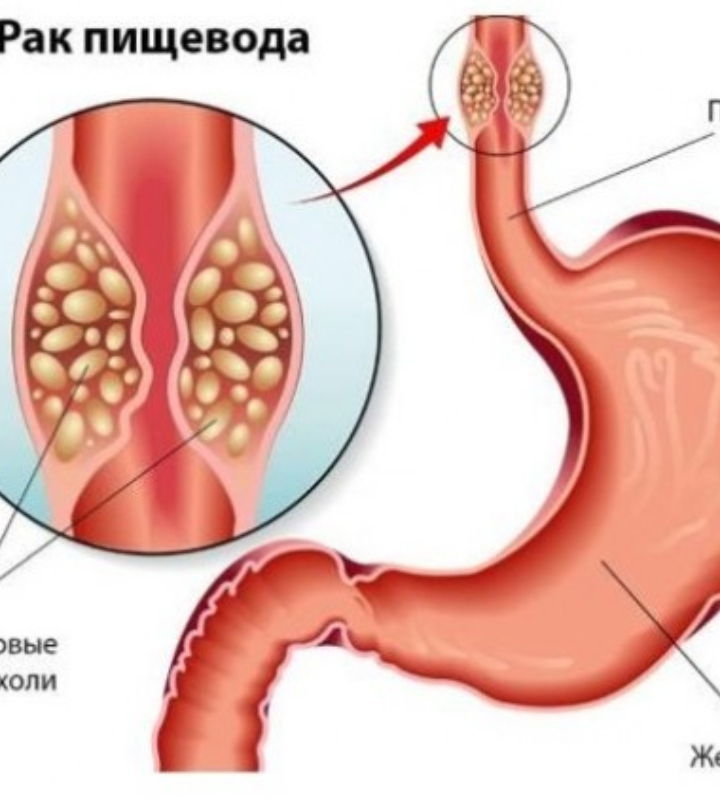 Родительница из штата Орегон получила тюремный срок из-за того, что не отпускала свою дочь-подростка на плановую операцию по поводу рака пищевода.