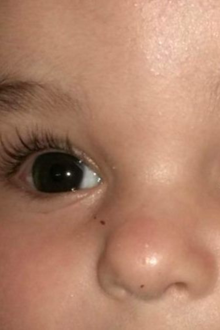 Аномальный белый блик в глазу называется лейкокория, он чаще проявляется у детей и может указывать на многие заболевания, в том числе такие серьёзные, как катаракта, токсокароз и ретинобластома — злокачественная опухоль сетчатки глаза.