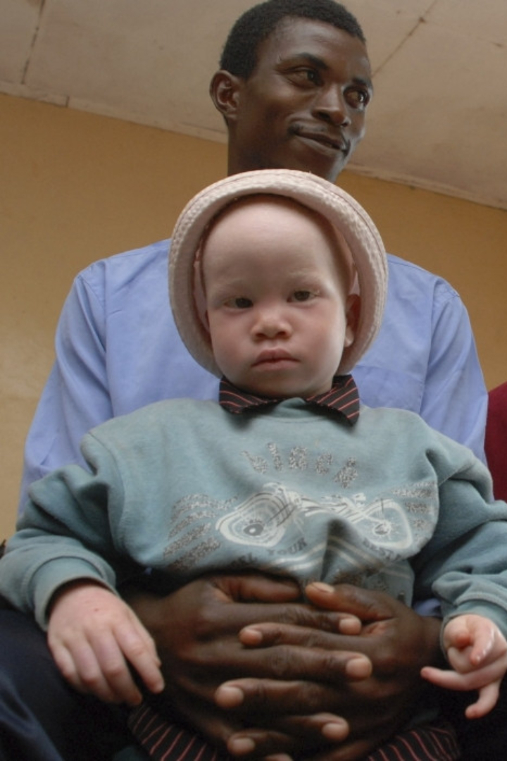 В мире в среднем один альбинос рождается на каждые 20 тысяч человек, но в Танзании и граничащих с ней странах Восточной Африки это соотношение совсем другое — 1:3000. 